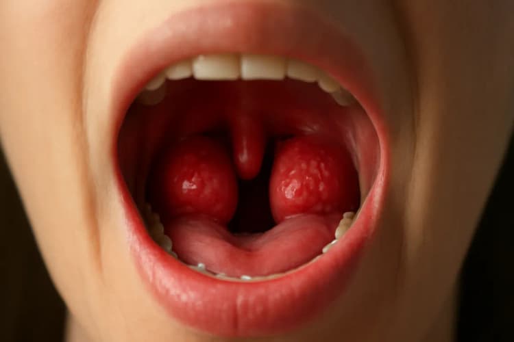 amígdalas inflamadas e doentes