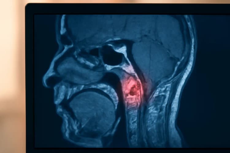 Imagem de ressonância magnética mostrando um tumor no osso mastoide